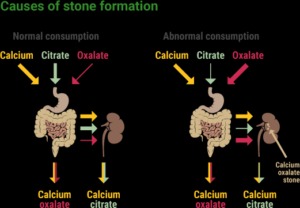 causes-of-stone-formation_2-300x